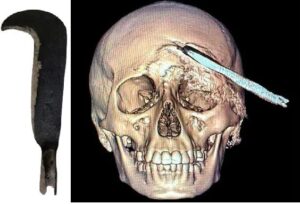 Este es el primer caso pediátrico en Yucatán con esta clase de lesión