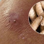 ¡Impactante! Séptimo caso de miasis en Yucatán pone en alerta a todos