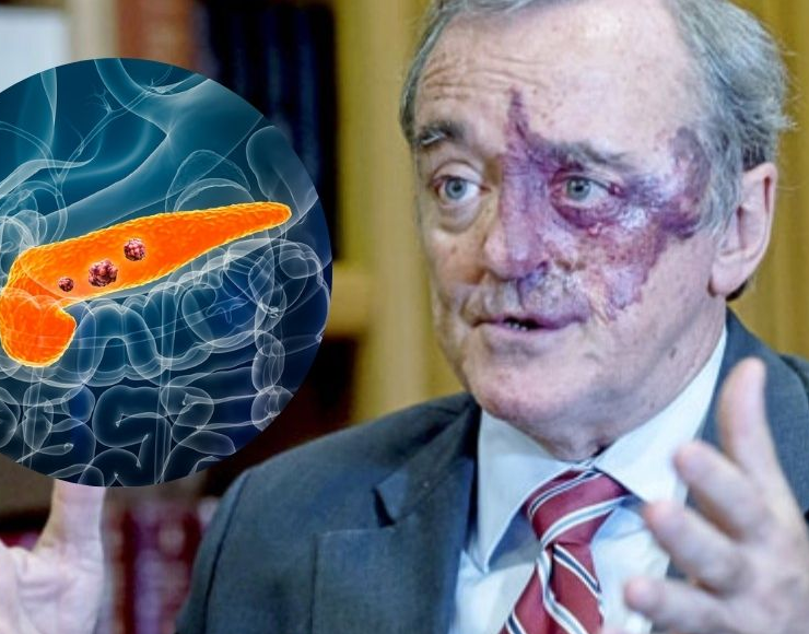 ¿España encuentra la cura contra el cáncer de páncreas?