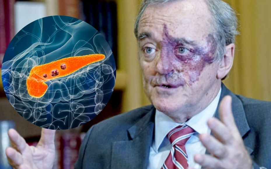 ¿España encuentra la cura contra el cáncer de páncreas?