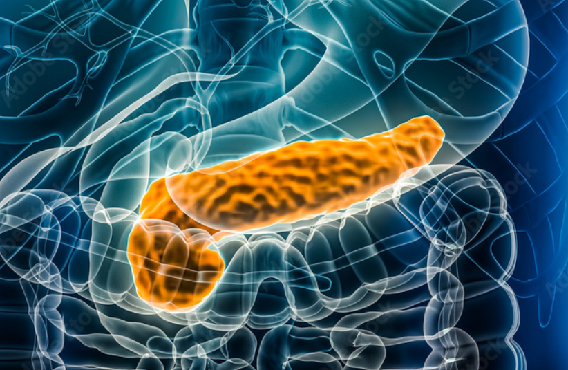 El adenocarcinoma ductal: un enemigo silencioso