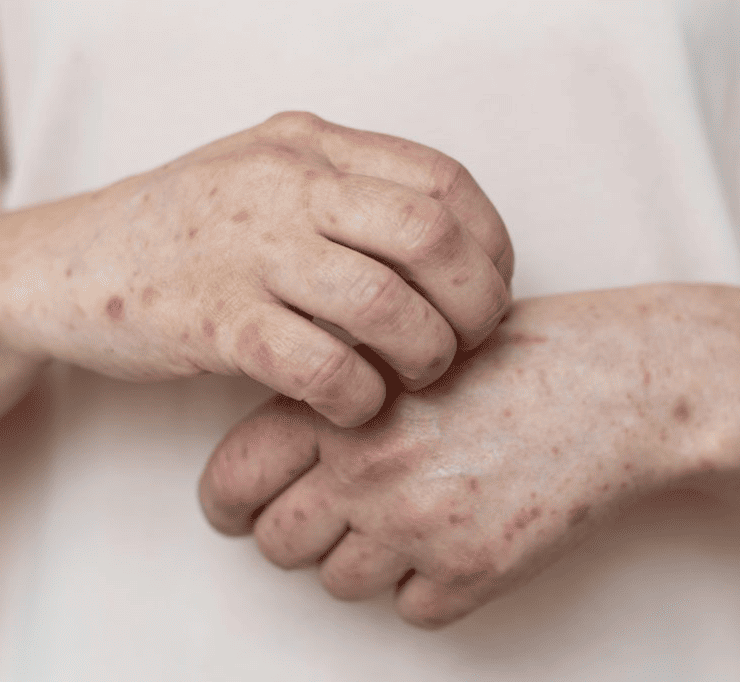 Detectan nuevos casos de sarampión en Tabasco