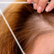 ¿Taiwán soluciona la calvicie? Nuevo tratamiento promete el crecimiento del cabello