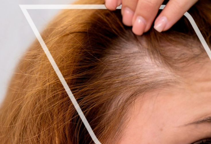 ¿Taiwán soluciona la calvicie? Nuevo tratamiento promete el crecimiento del cabello