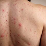 México refuerza cerco sanitario ante repunte histórico de sarampión en América