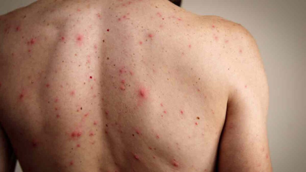 México refuerza cerco sanitario ante repunte histórico de sarampión en América