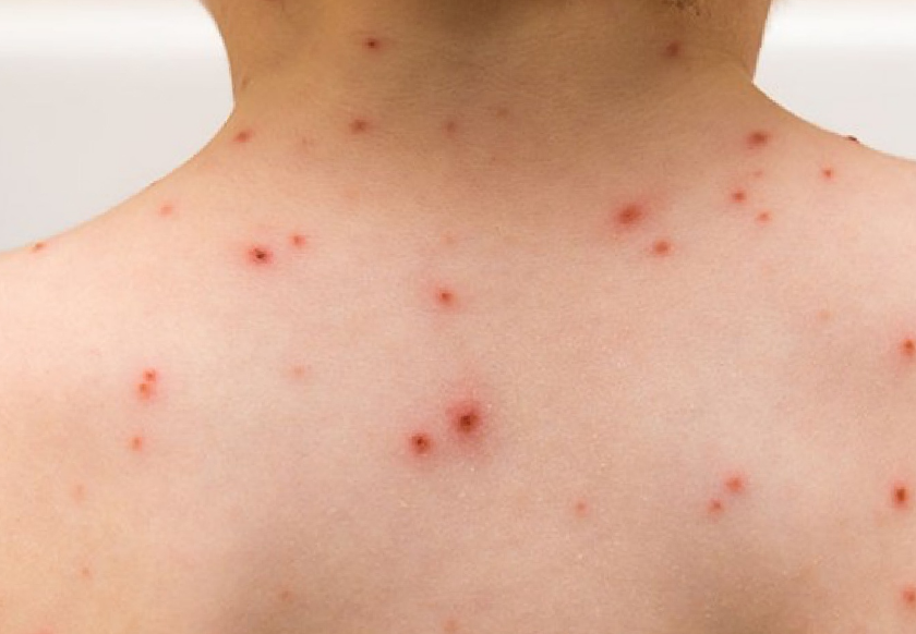 Aumentan casos de varicela en Campeche y preocupa a padres