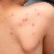 Aumentan casos de varicela en Campeche: Prevención y alerta
