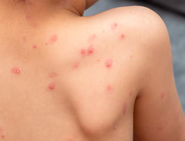 Aumentan casos de varicela en Campeche: Prevención y alerta
