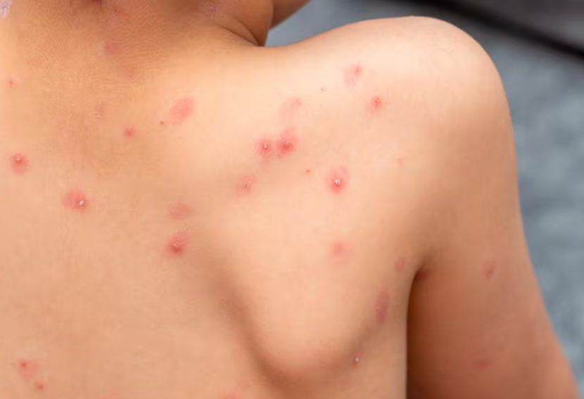 Aumentan casos de varicela en Campeche: Prevención y alerta