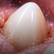 El primer "regenerador" dental entra en fase de pruebas