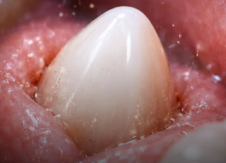 El primer "regenerador" dental entra en fase de pruebas