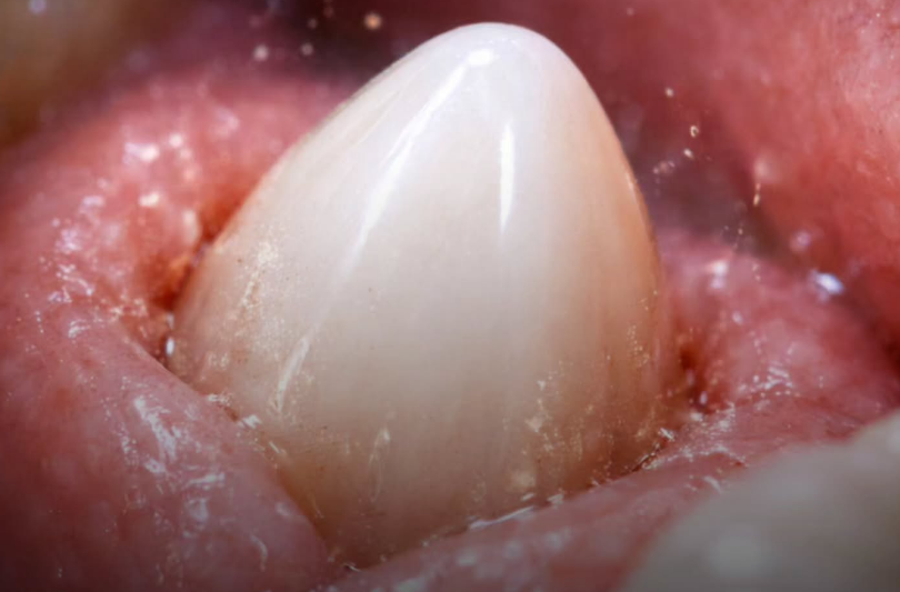 El primer "regenerador" dental entra en fase de pruebas