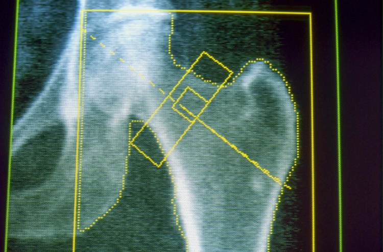 El Ozempic podría aumentar el riesgo de osteoporosis y gota