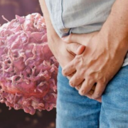 Se dispara ciclosporiasis en Texas, fuerte infección intestinal