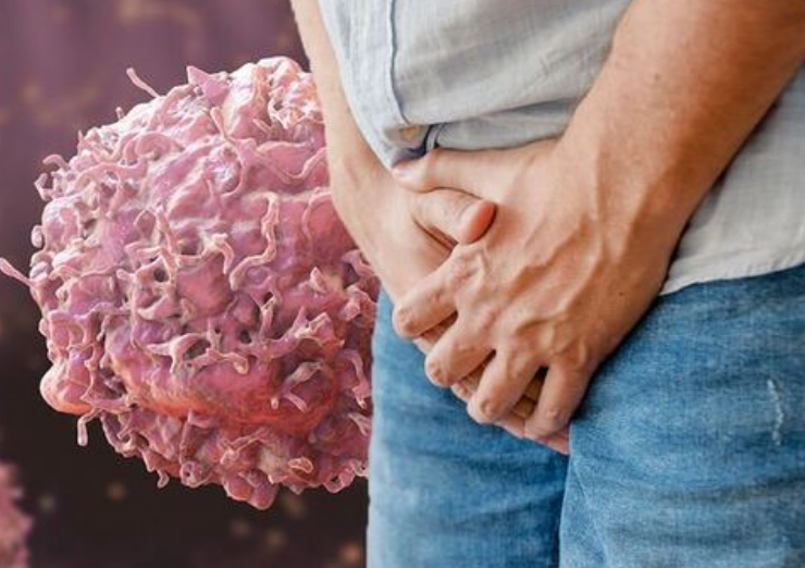 Se dispara ciclosporiasis en Texas, fuerte infección intestinal