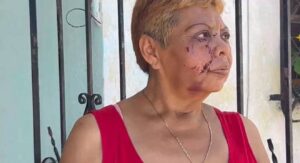 La mujer de la tercera edad resultó gravemente herida tras ser atacada por perros Pitbull en la colonia Bojórquez, al poniente de Mérida.