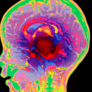 Nueva terapia muestra resultados prometedores contra tumores cerebrales infantiles