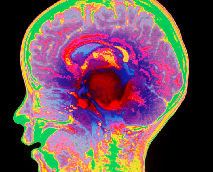 Nueva terapia muestra resultados prometedores contra tumores cerebrales infantiles