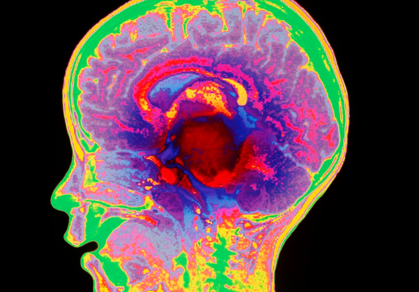 Nueva terapia muestra resultados prometedores contra tumores cerebrales infantiles