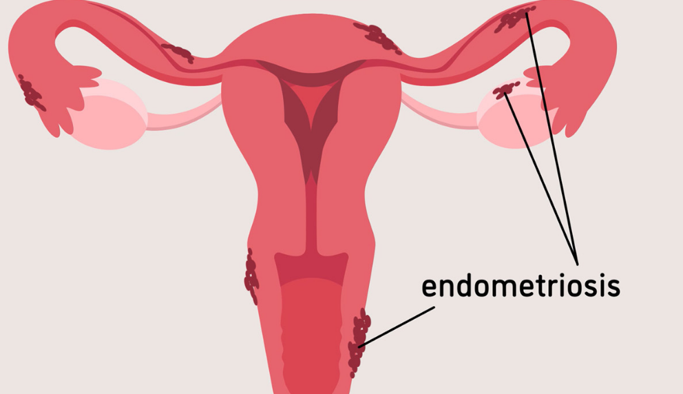 ¿Qué establece la reforma sobre la endometriosis y padecimientos ginecológicos?