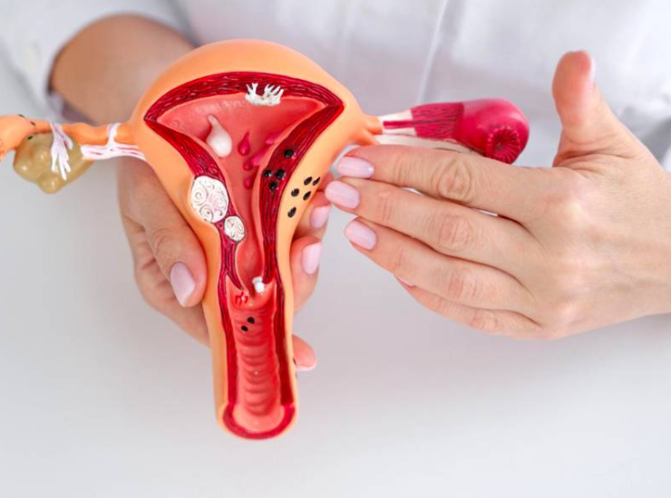 Una nanoterapia contra la endometriosis, avance médico