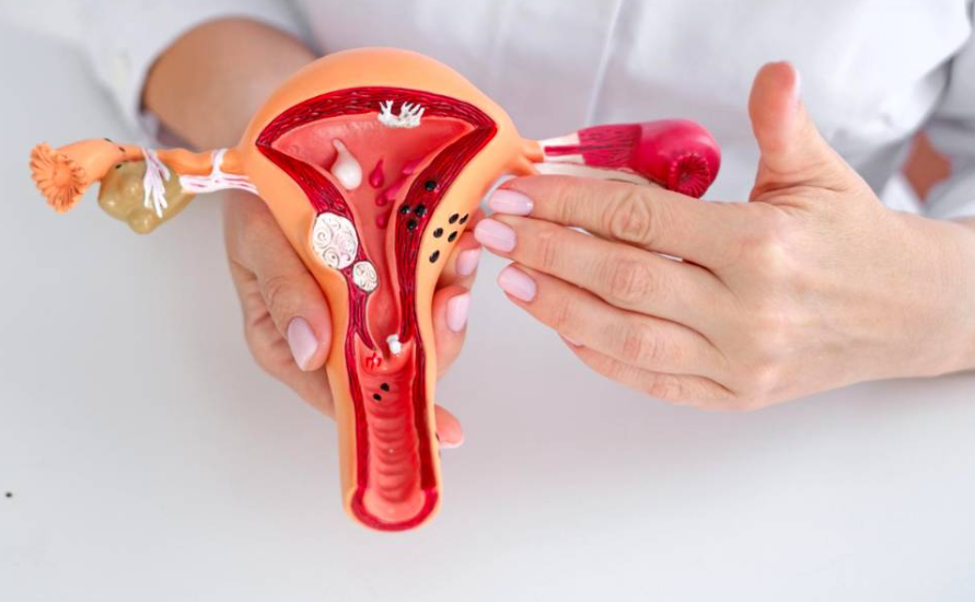 Una nanoterapia contra la endometriosis, avance médico